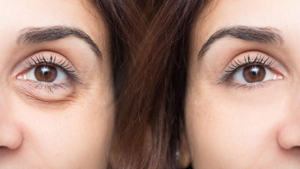 Look Younger Instantly with PRP Under-Eye Injections in Pittsburgh!